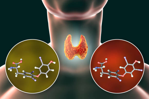 hashimoto's disease treatment